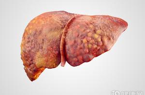 Does the prime criminal of liver cirrhosis have al
