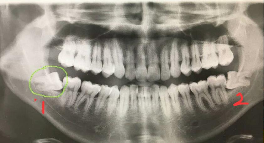 这样的智齿一定不能留,下颌埋伏阻生牙齿会 - 今日头条(www.toutiao.com)