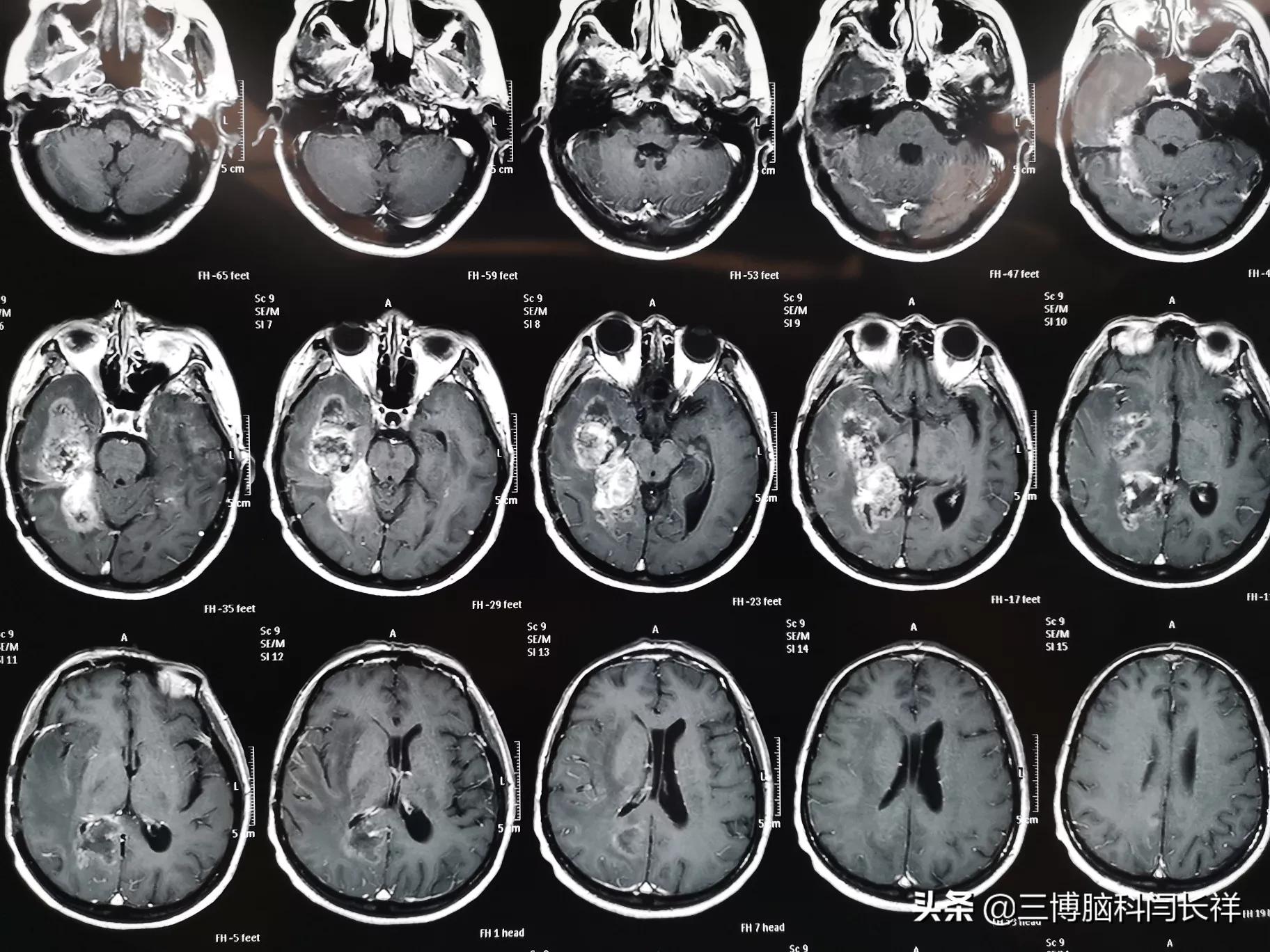 再谈胶质瘤的治疗_胶质瘤 - 好大夫在线